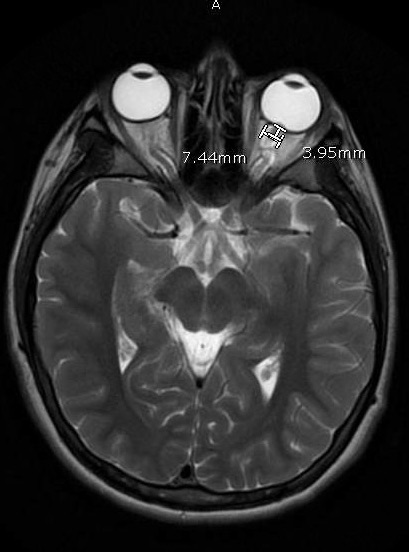 semaglutide intracranial hypertension Isolated Idiopathic Intracranial Hypertension as the Initial Presentation of Pediatric Lupus