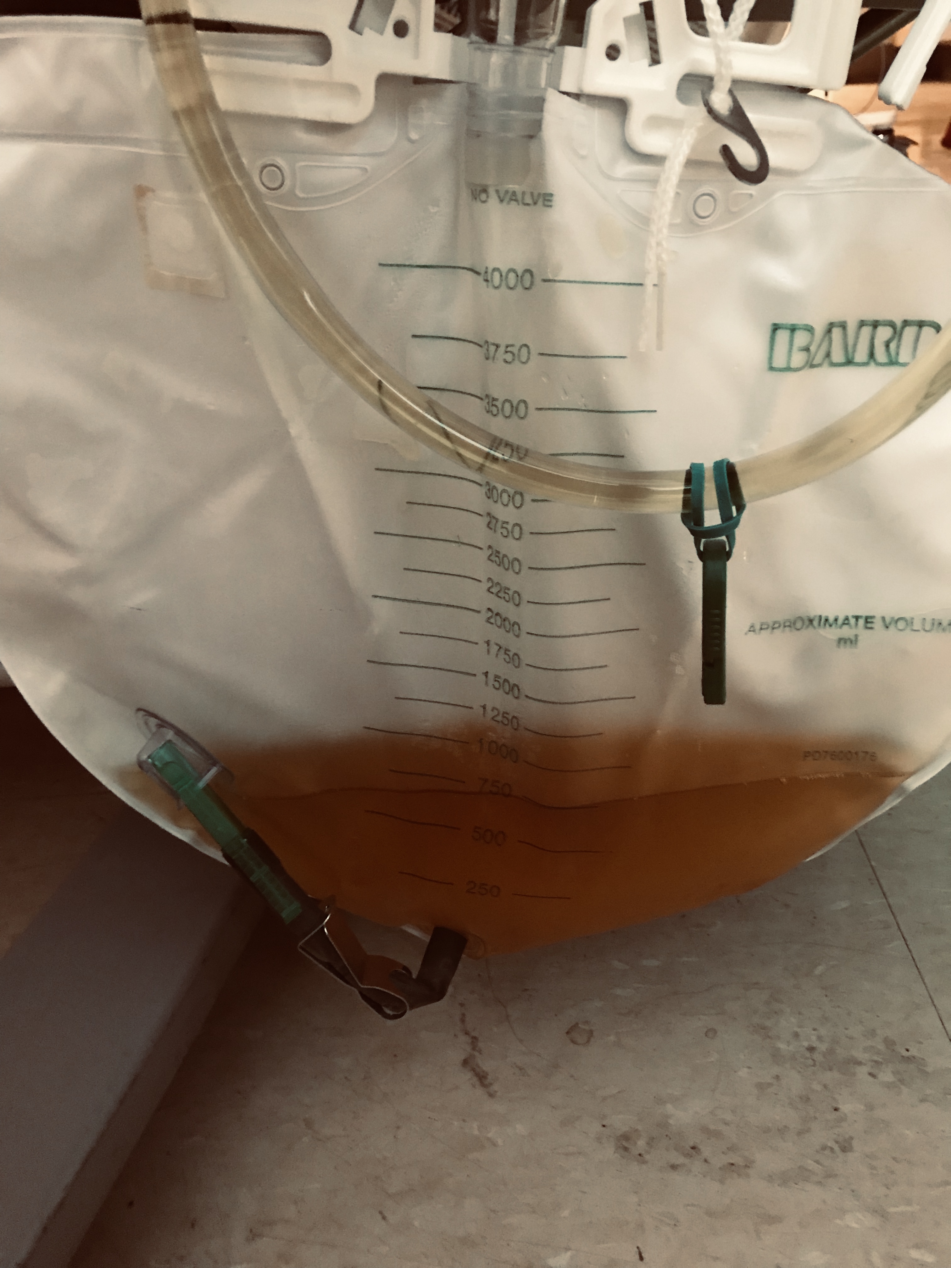 semaglutide dark urine Metronidazole-Induced Encephalopathy From Prophylactic Treatment of an  Infected Abdominal Mesh