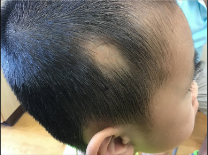 tirzepatide alopecia Temporal Triangular Alopecia