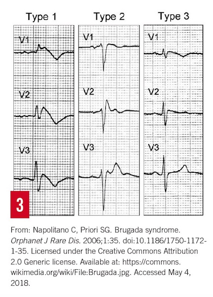 Brugada figure 3