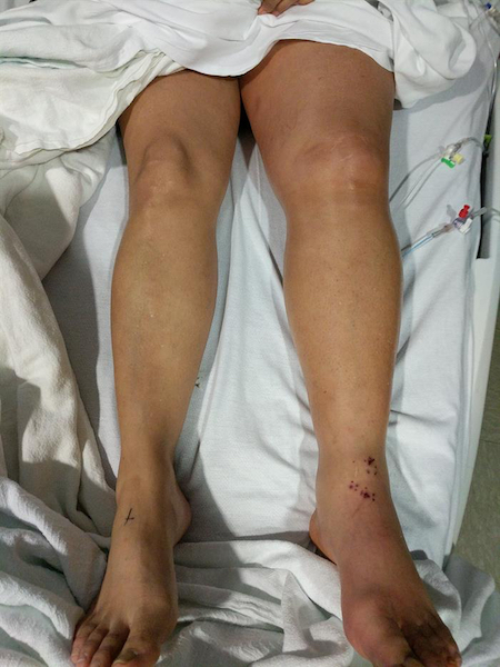 deep vein thrombosis figure 4