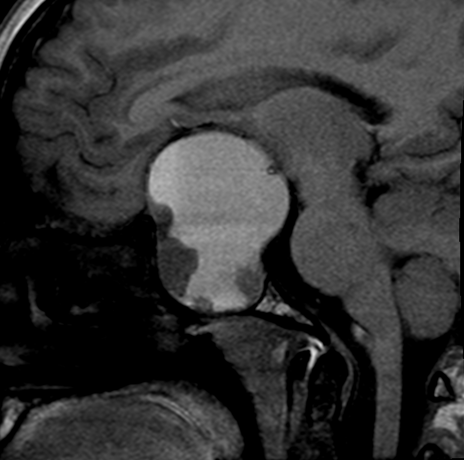 prolactinoma migraine fig 1