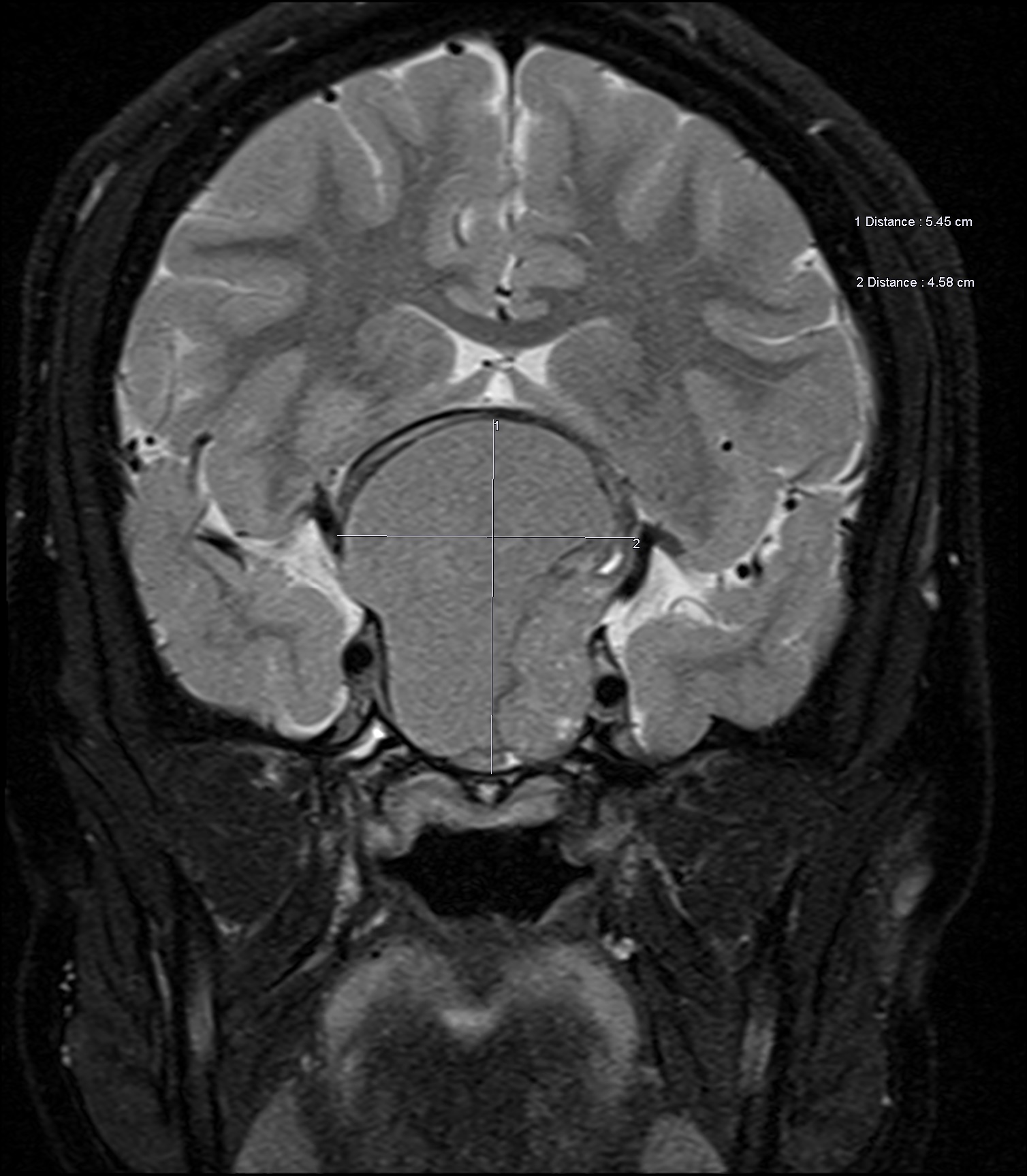 prolactinoma migraine fig 3