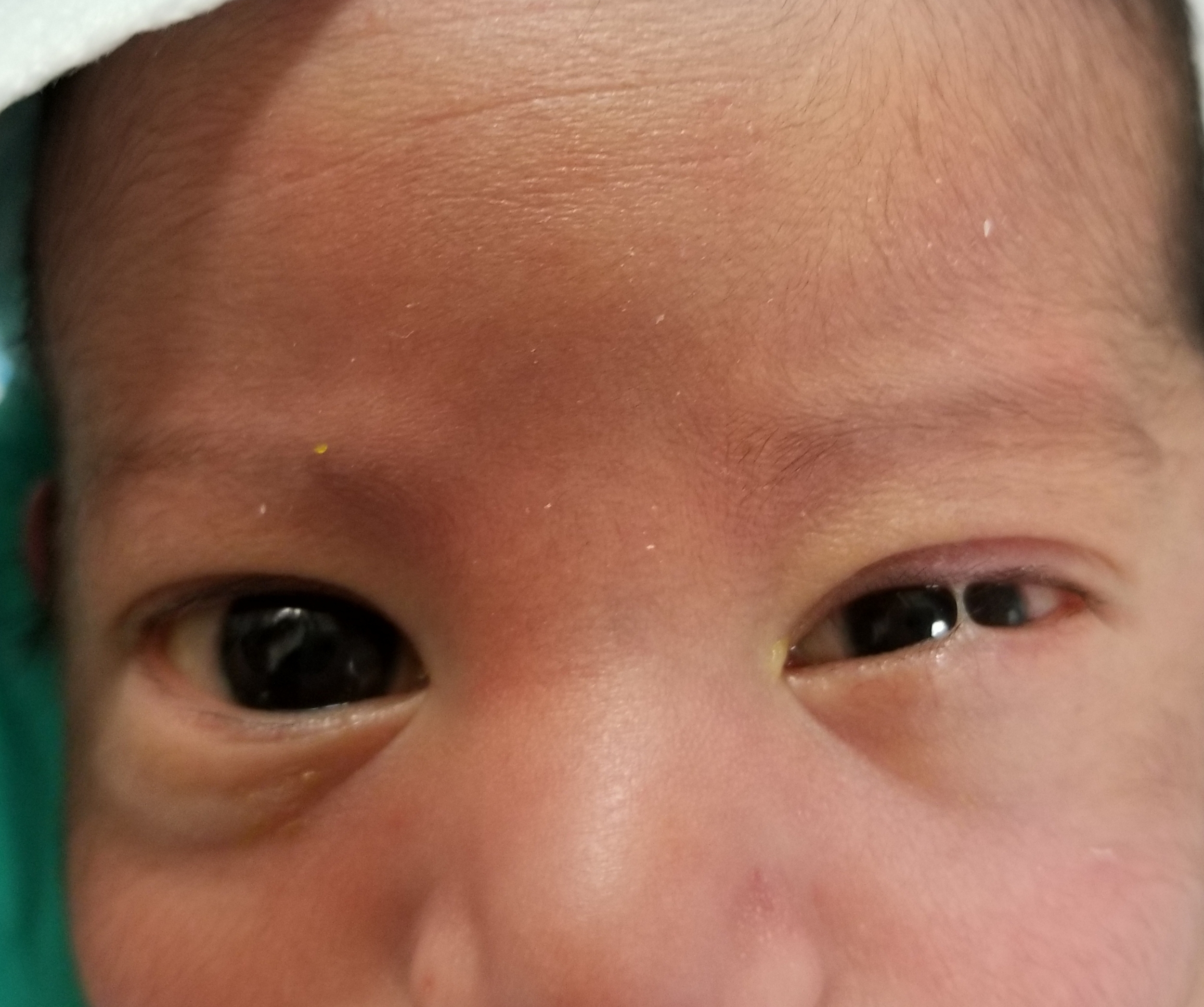 ankyloblepharon filiforme adnatum