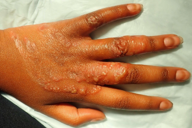 tinea of the hand and fingers