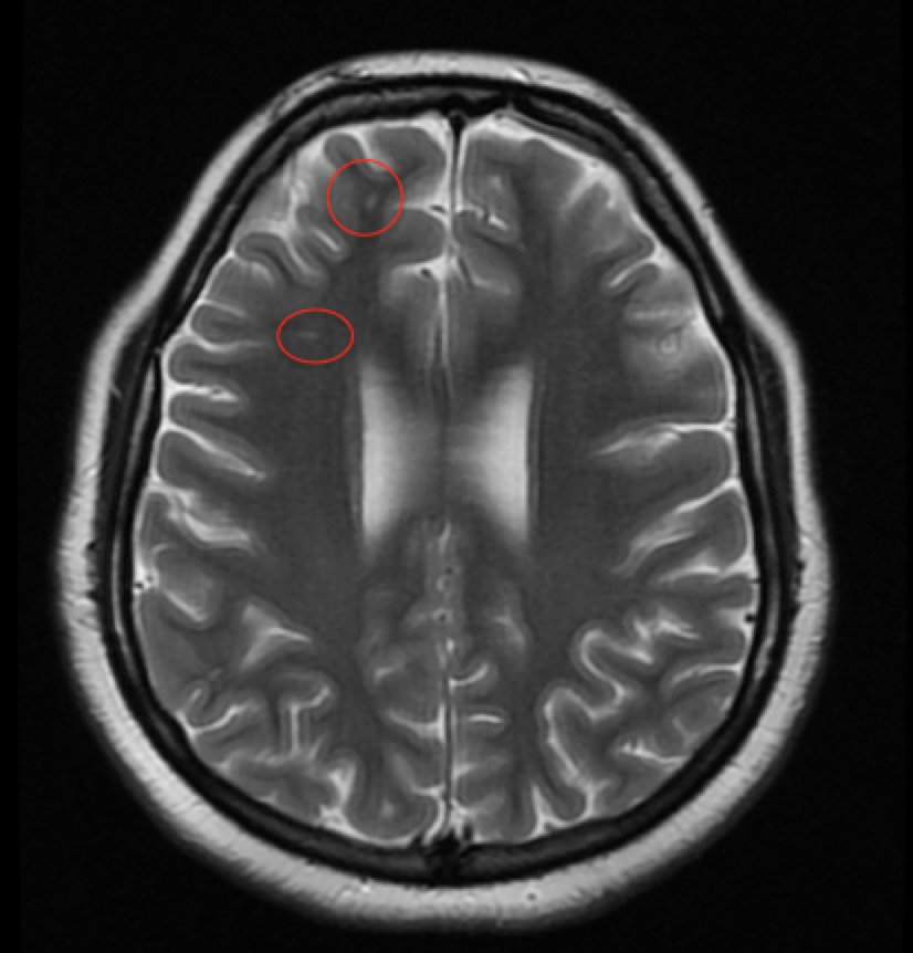 Migraine MRI