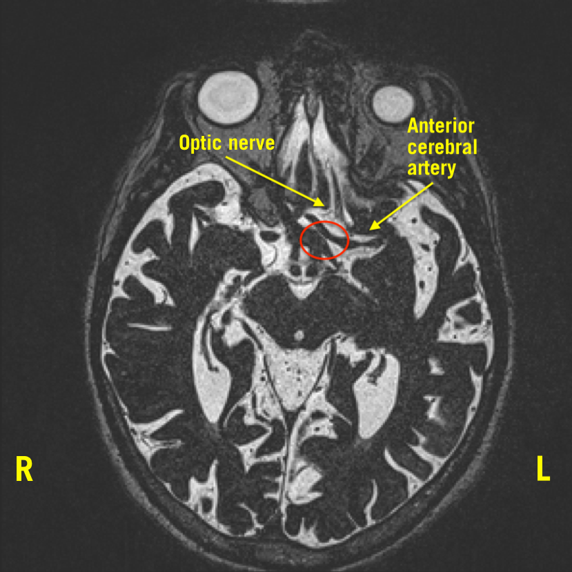 Figure 1 head MRI