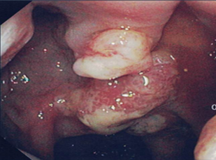 Fig 1b colonoscopy