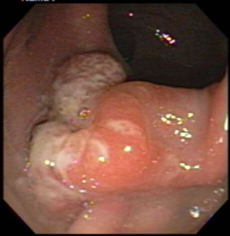 Fig 3 colonoscopy 