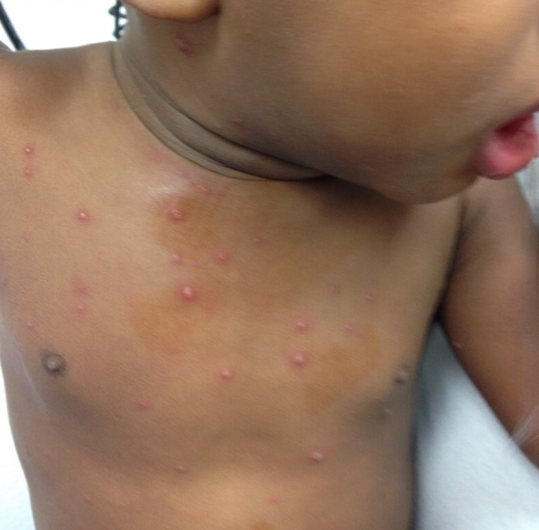 Chickenpox Figure 1