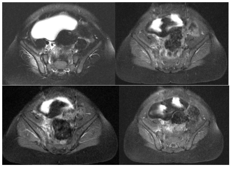 Figures. MRI series showed a slight reduction in the normal T1-weighted marrow signal with concordant T2-weighted signal hyperintensity and postcontrast enhancement involving the right iliac wing below the crest, extending to the roof of the acetabulum, findings consistent with acute osteomyelitis. No evidence of fracture or dislocation or avascular necrosis was visible.