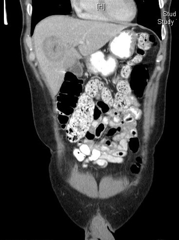 IgG4-RD Figure 4