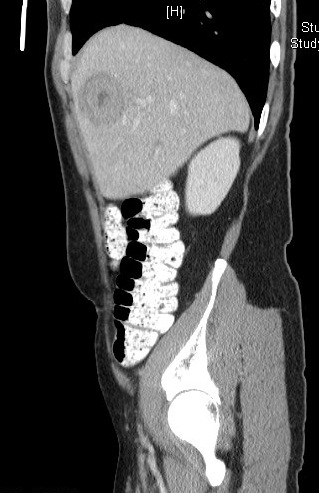 IgG4-RD Figure 5