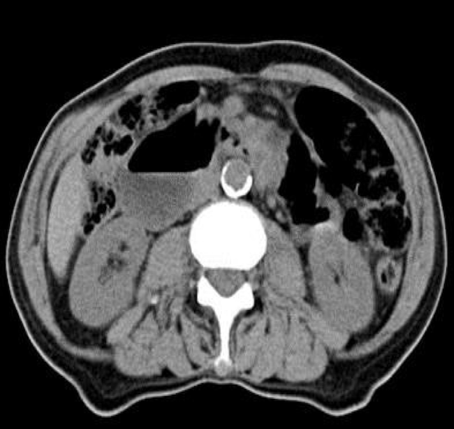 Duodenal Adenocarcinoma