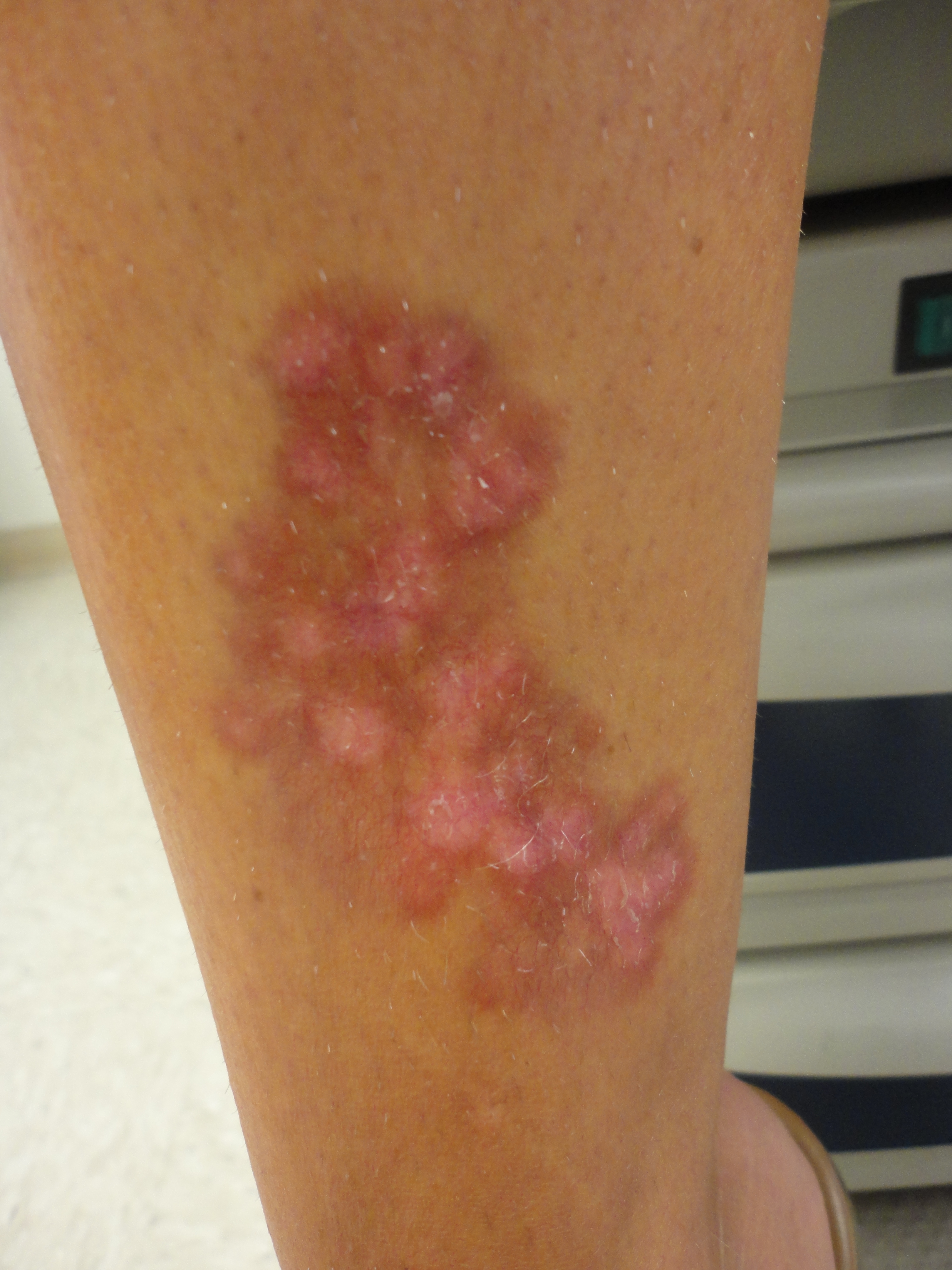 necrobiosis lipoidica