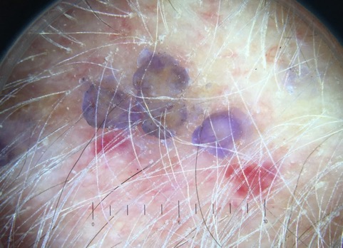 purple papules fig 1