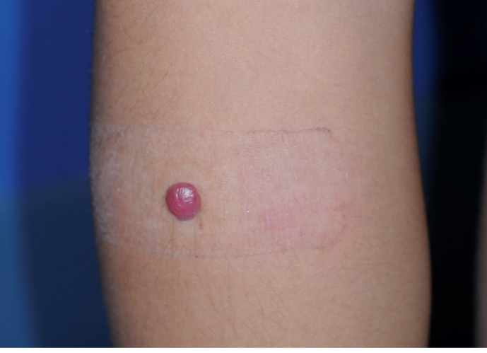 Spitz nevus