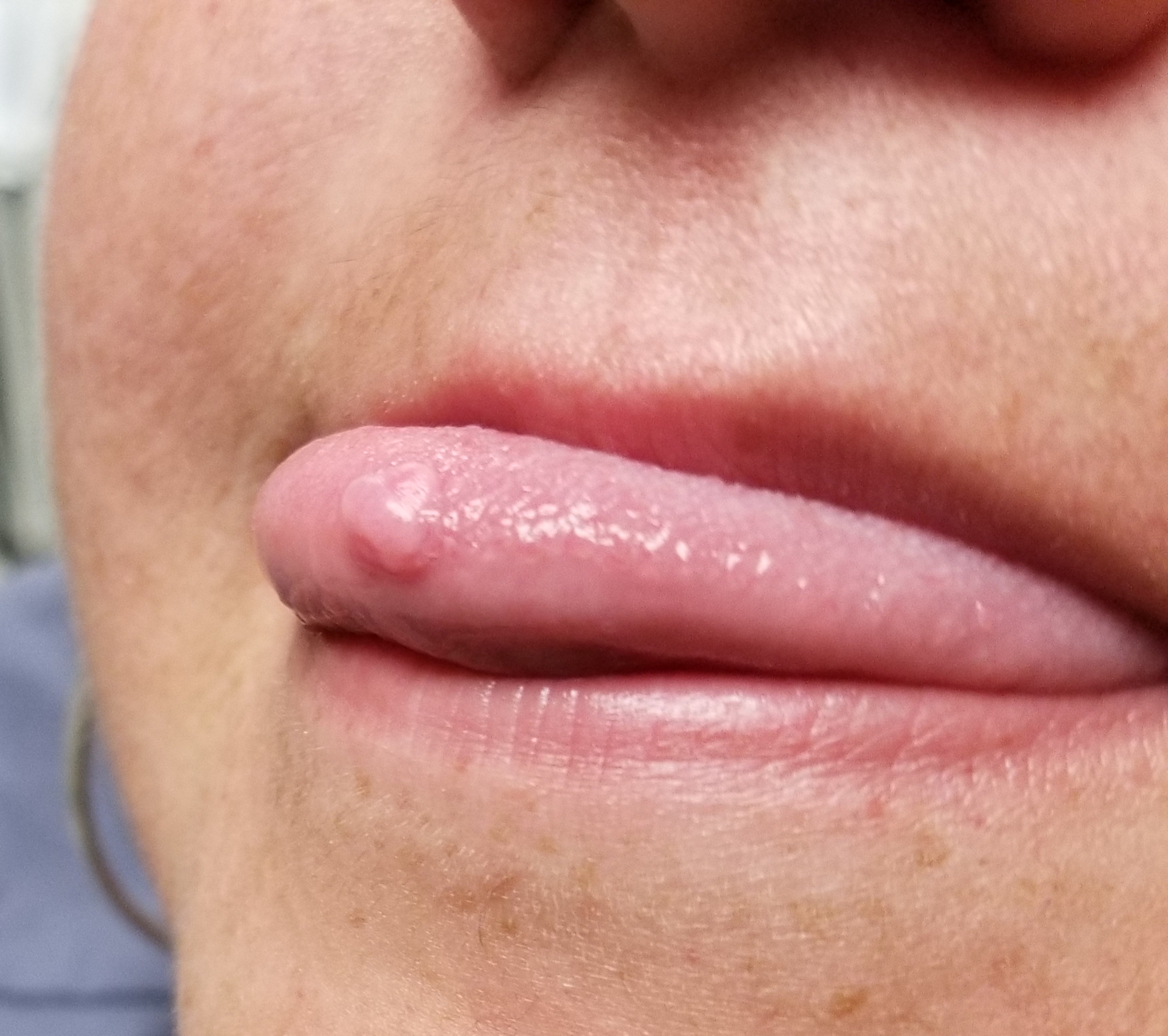 oral traumatic fibroma