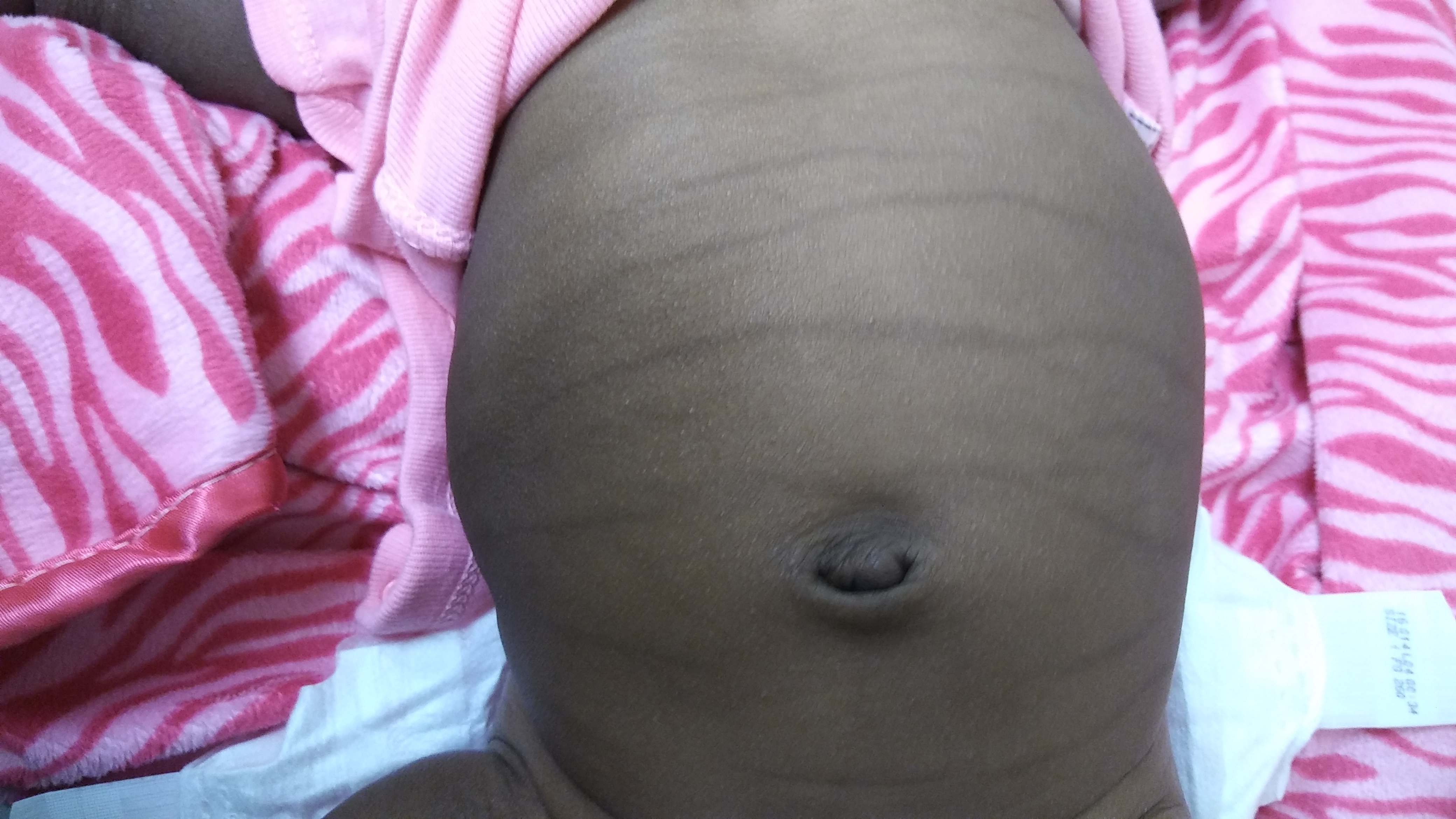 Pigmentary lines of the newborn