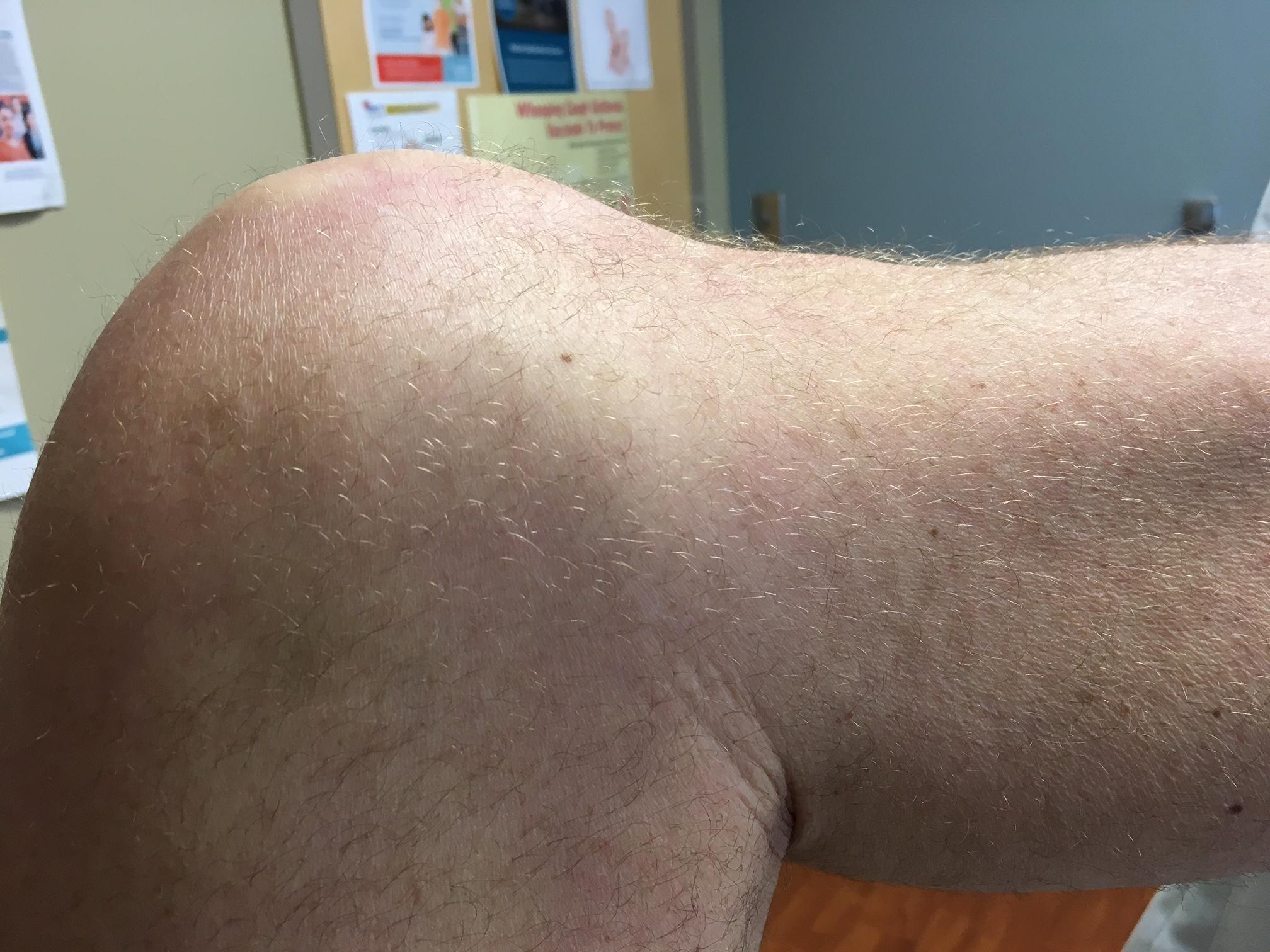 Figure 1a. A positive posterior sag sign on the left knee.