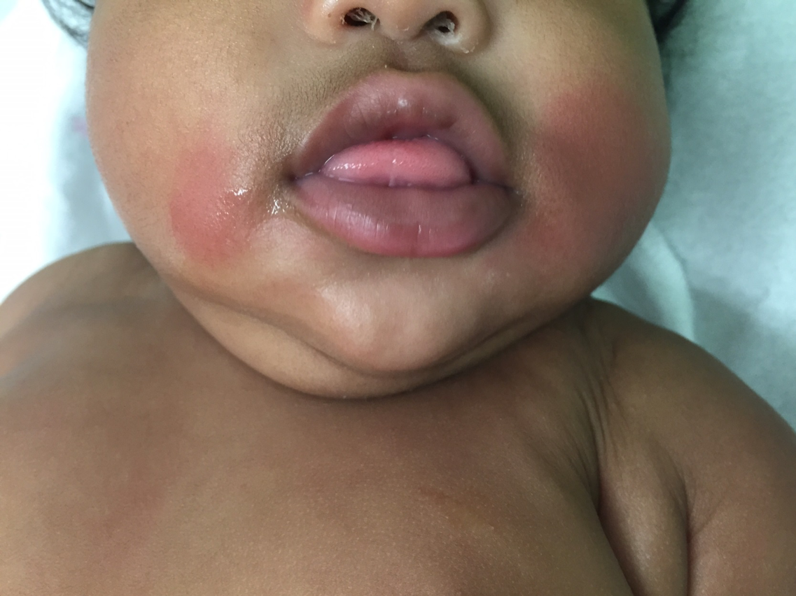 Popsicle panniculitis