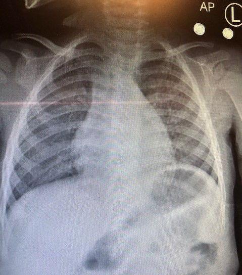 Chest radiograph