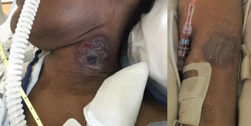 Ulcerative skin lesions