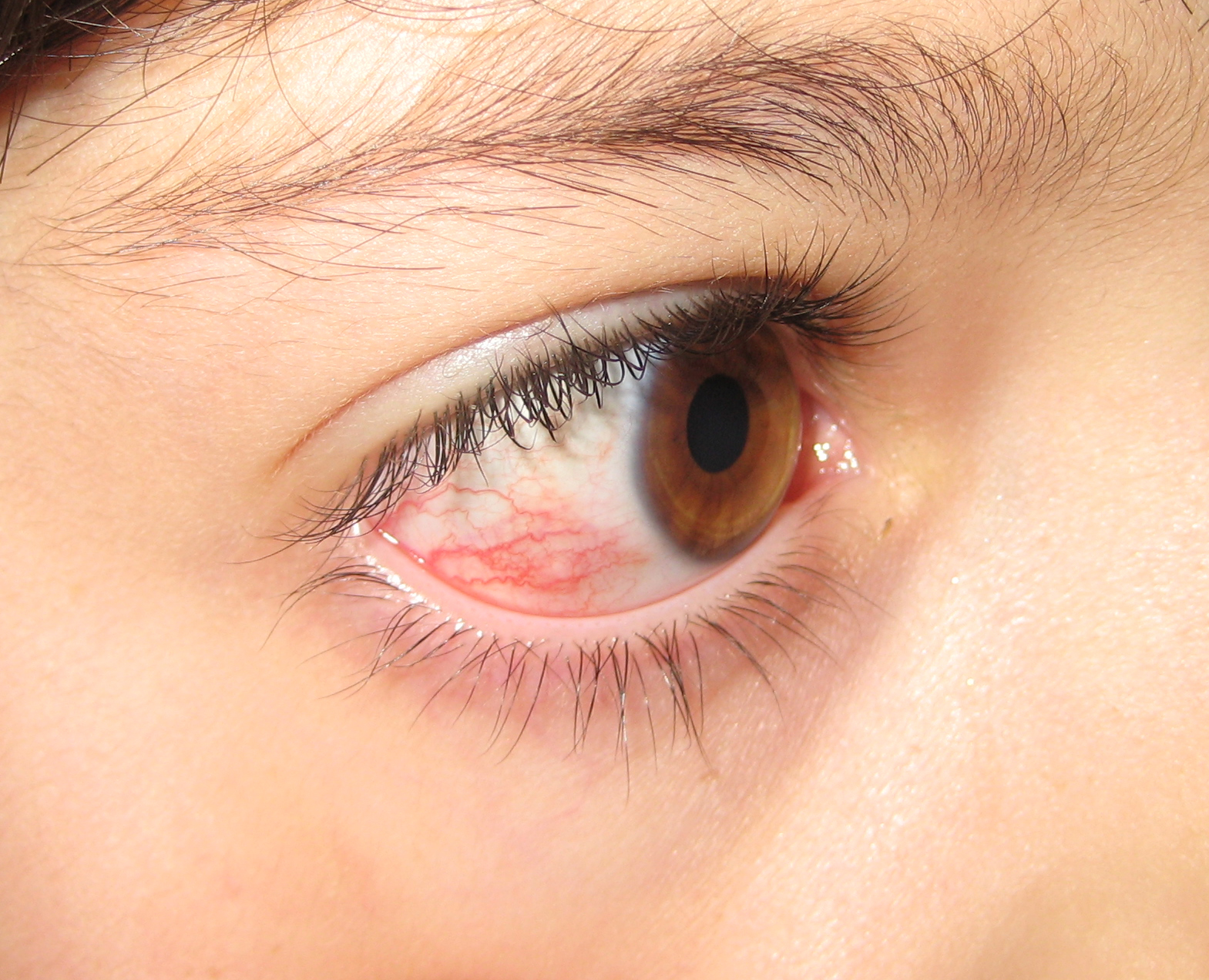 Figure 1. An 8-year-old girl presented with an area of injection of the right eye.