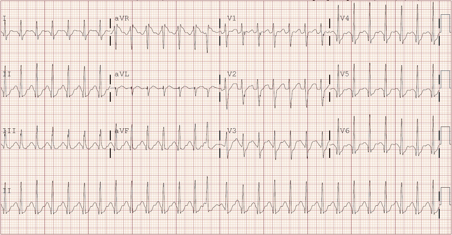 Figure 1. ECG at time of ingestion showed ST-segment depression, prolonged QTc, sinus tachycardia, interventricular conduction delay, and bilateral atrial enlargement.