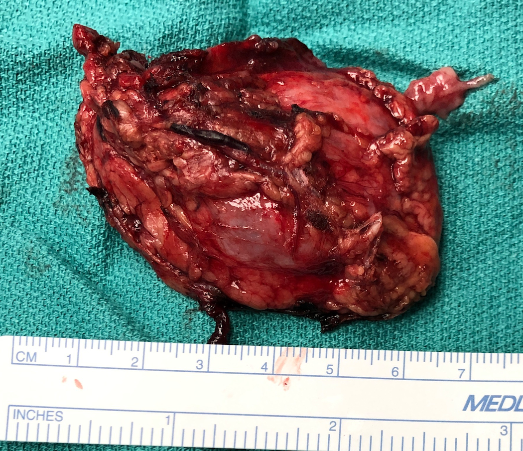 Pheochromocytoma