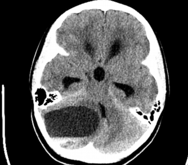 Fig 1 CT scan