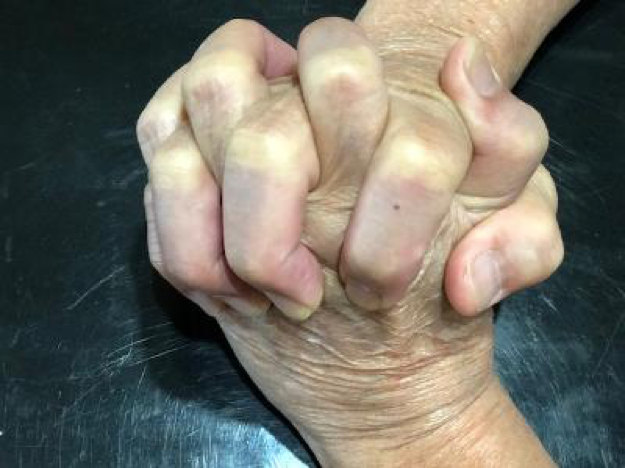 Squeezing Hand Technique