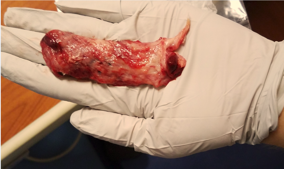 Figure -- decidual cast