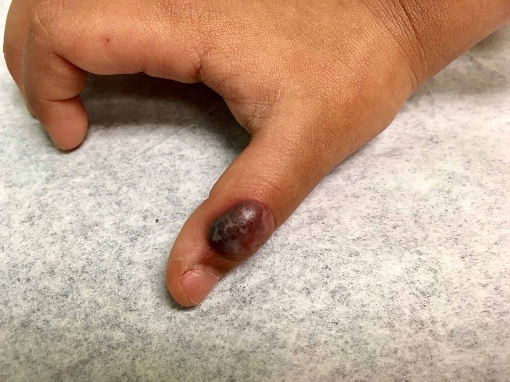 bullous impetigo photo