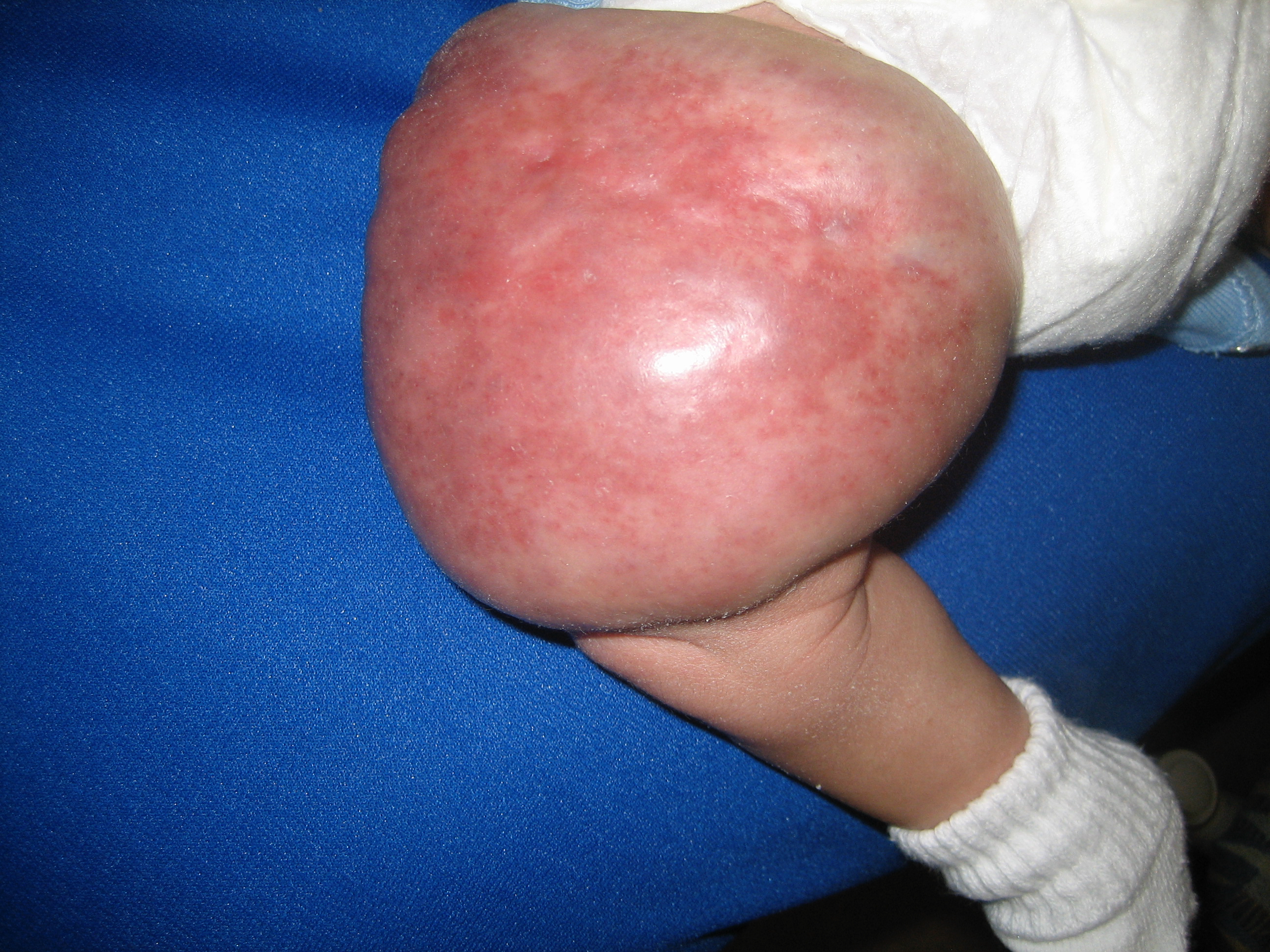 Figure 3. A noninvoluting congenital hemangioma on the right thigh of a 4-year-old child.
