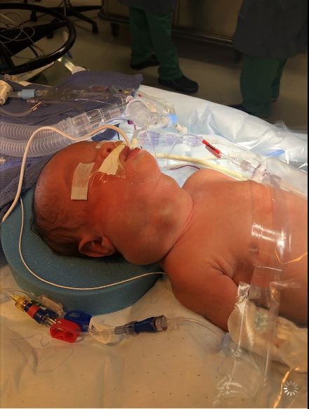 Figure 2. Physical examination revealed a large anterior lobulated neck mass extending from right side of the neck.