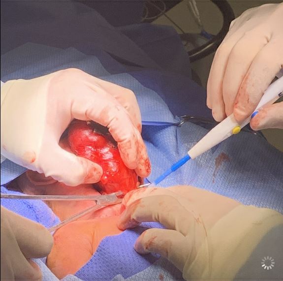 Figure 5. Intraoperative photograph of teratoma removal in the operating room.
