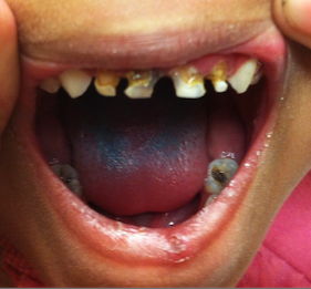 early childhood caries figure 1