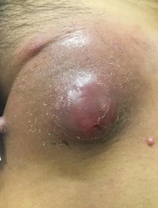 Figure 1. Large erythematous firm-to-hard inguinal lymph node masquerading as a cyst on the left inguinal fold with overlying erosions and few satellite erythematous papules.