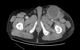 Figure 2. Repeat CT scan of the abdomen and pelvis revealed the left heterogeneous inguinal mass with multiple enlarged lymph nodes/masses.