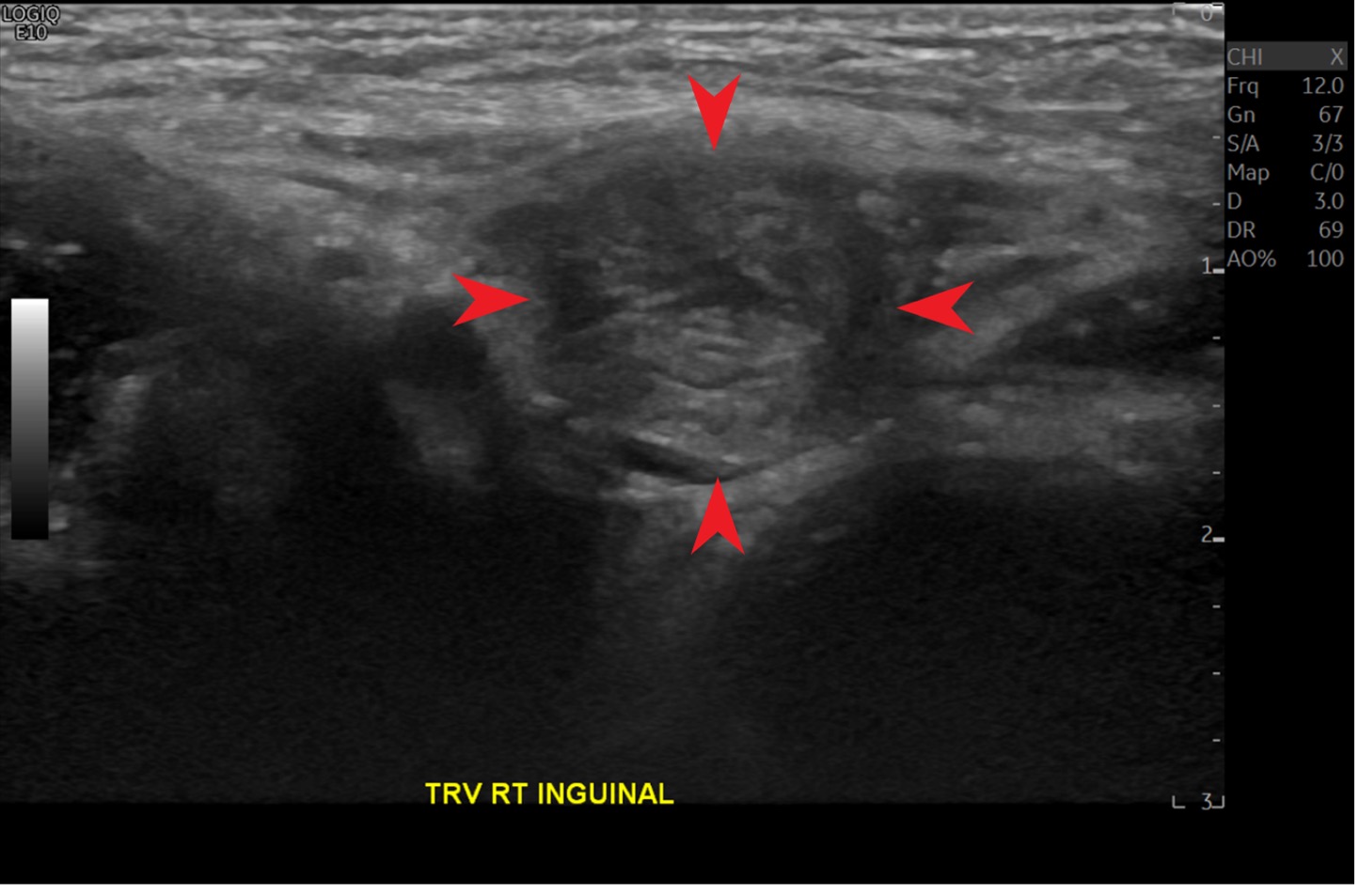Figure 1. A right inguinal canal with hernia sac is identified (arrows)