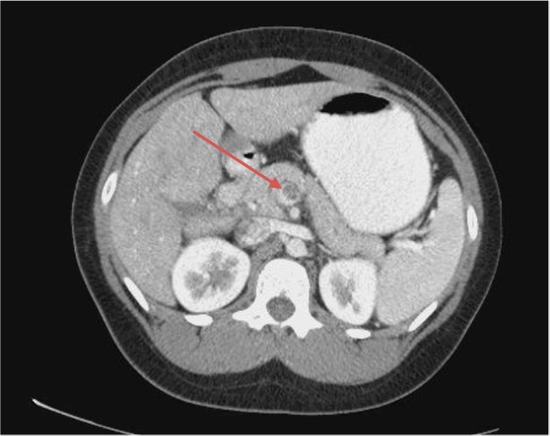 Figure 1. A CT scan of the abdomen showed superior mesenteric vein thrombosis (arrow).