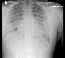 Figure 1. A chest radiograph on the day of admission showed perihilar interstitial prominence with superimposed patchy airspace opacities.