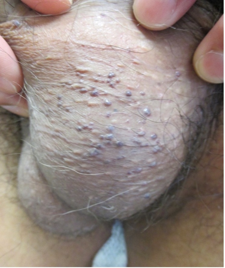 Figure 1. Angiokeratoma of Fordyce presents as multiple, well-circumscribed, dome-shaped papules mainly on the scrotum in men.