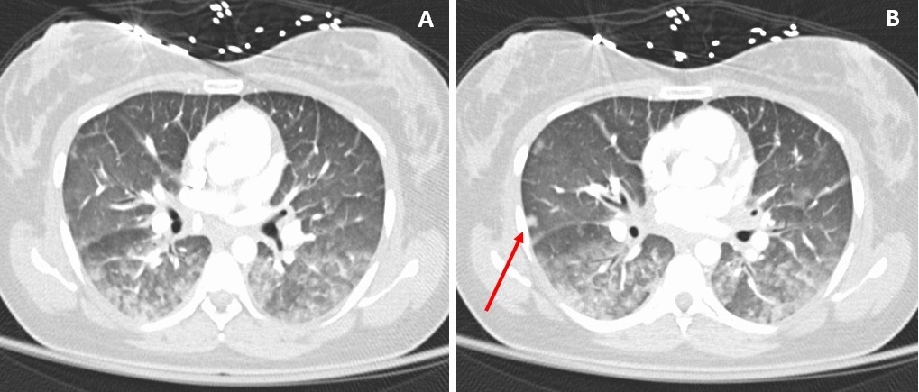 Figure 1. A computed tomography scan showed extensive bilateral, posterior lung opacities with infiltrate process involving the mediastinum, suggestive of pneumonia (A). A 7-mm nodule was also noted in periphery of the right middle lobe (B).