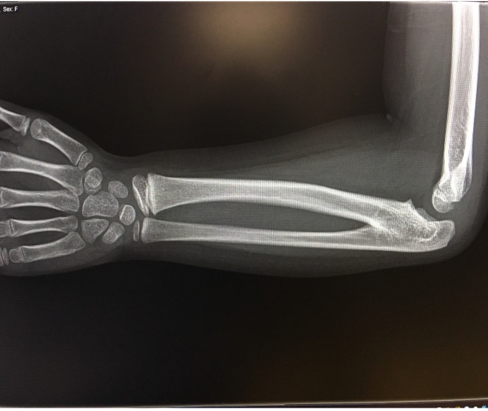 Figure 1. A radiology scan of the patient’s upper left extremity, lateral view.
