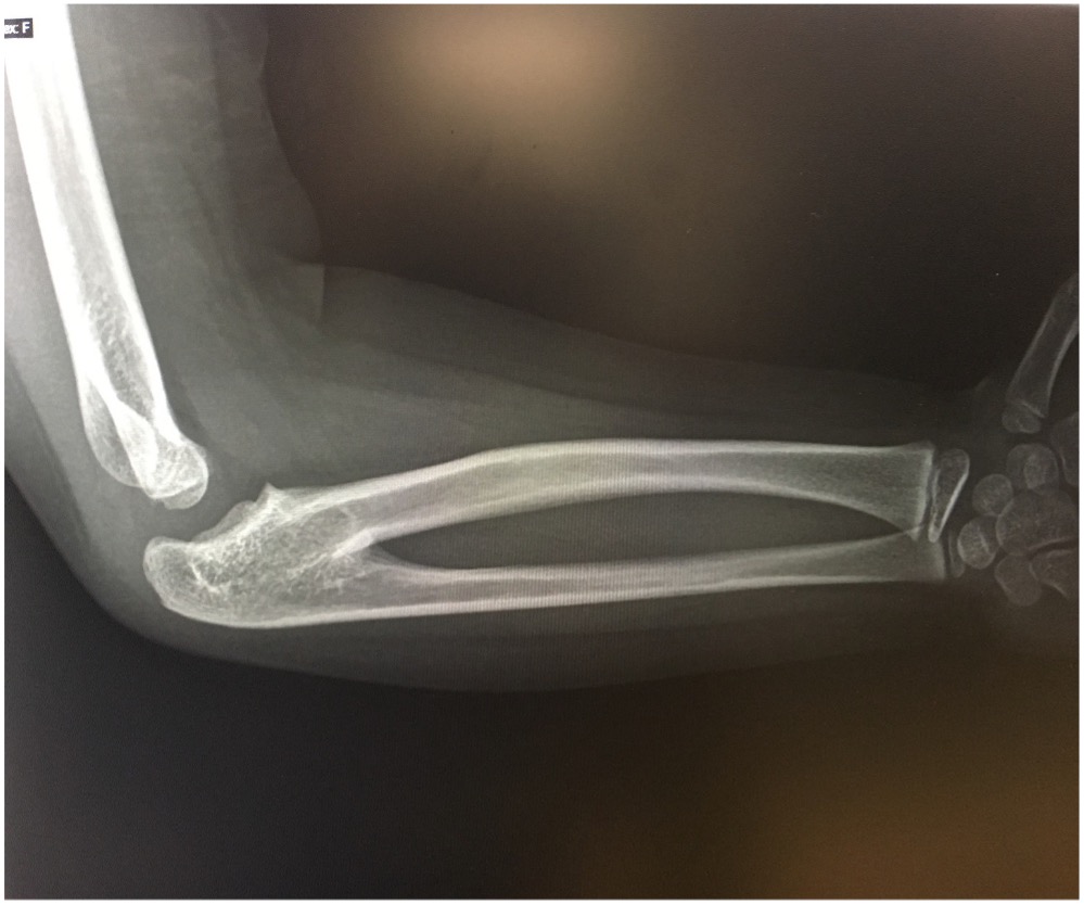 Figure 3. A radiology scan of the patient’s upper right extremity, lateral view.