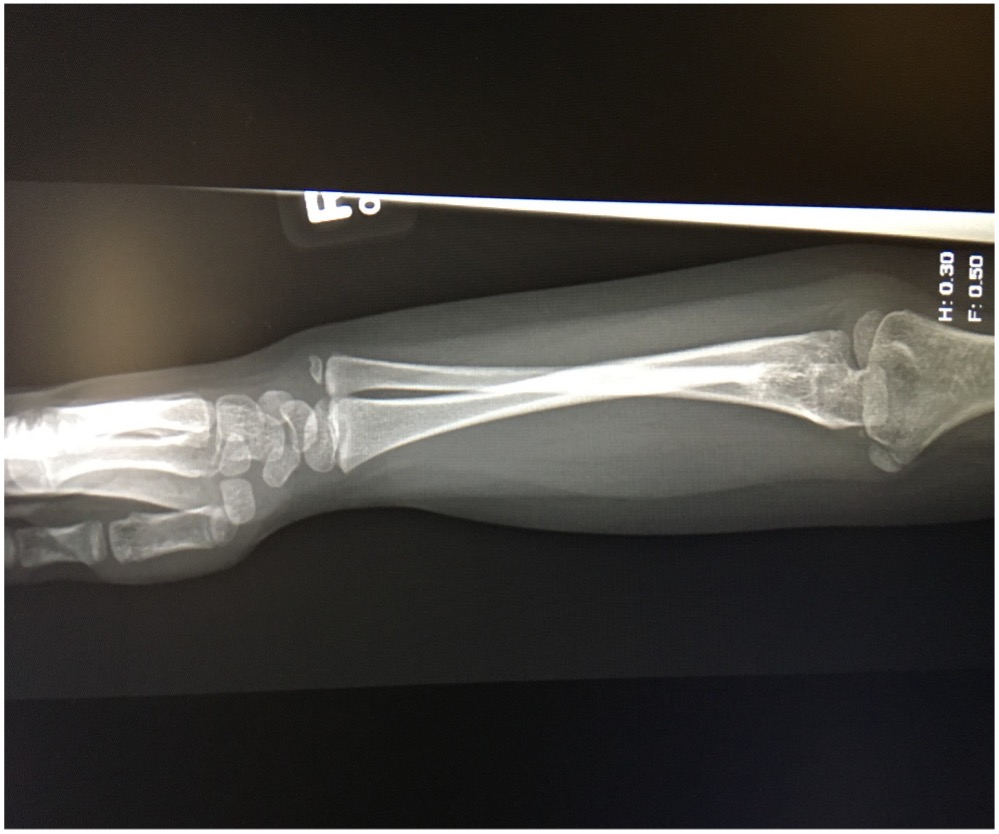 Figure 3. A radiology scan of the patient’s upper right extremity, medial view.