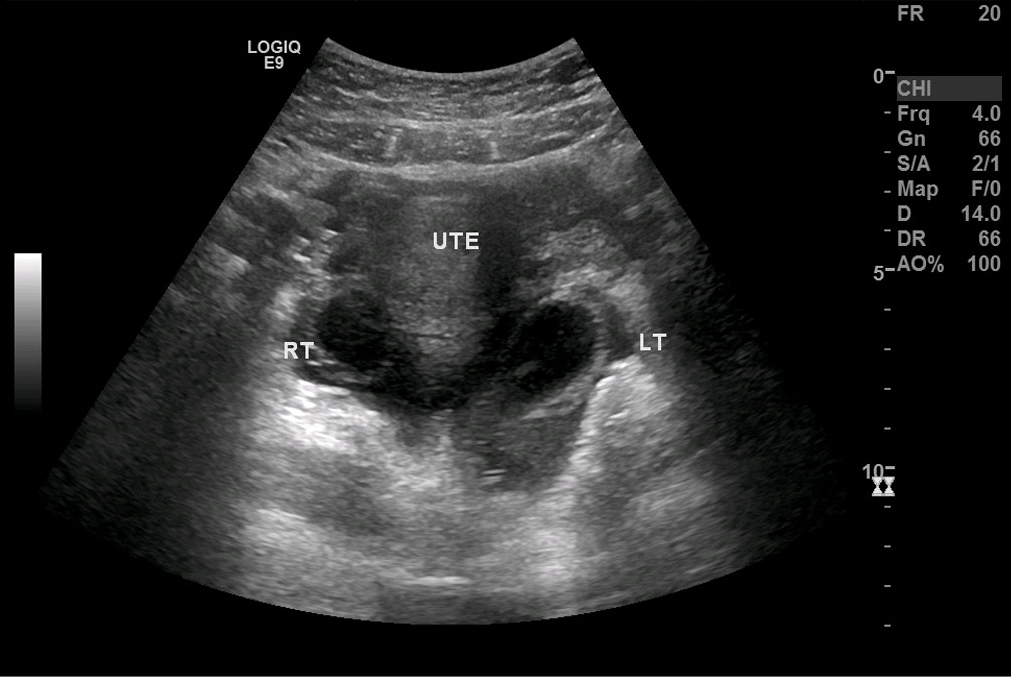Figure 2. A computed tomography scan of the patient’s abdomen confirmed left fallopian tube torsion.