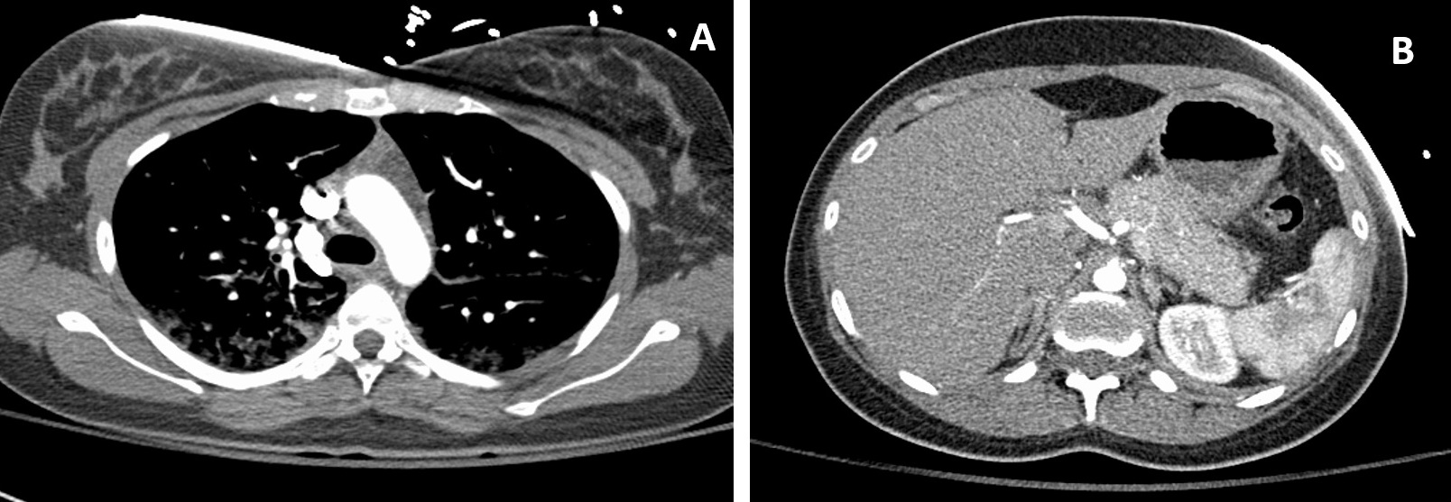 Figure 2. A computed tomography scan showed prominence of the thymic gland, presumably because of thymic hyperplasia (A). Prominence of the pancreas was also noted, with loss of interdigitations (B).